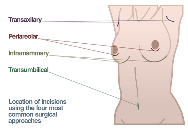 Breast Implant Options in Las Vegas & Henderson, NV