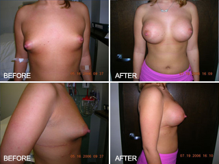 Vegas Breasts