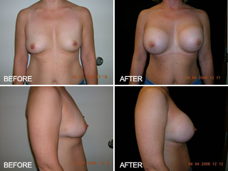 Vegas Breasts