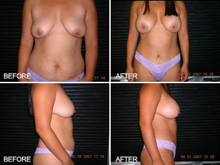 Vegas Breasts